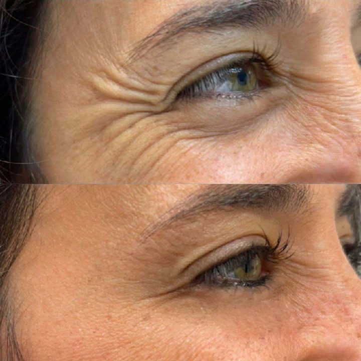 Crows Feet Before and After Botox