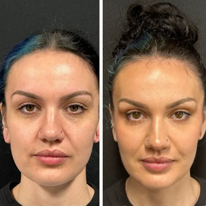 Daxxify vs Botox cost