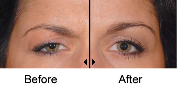 Dysport Before and After Eyes