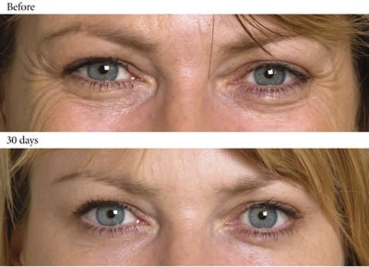 Dysport Before and After Eyes