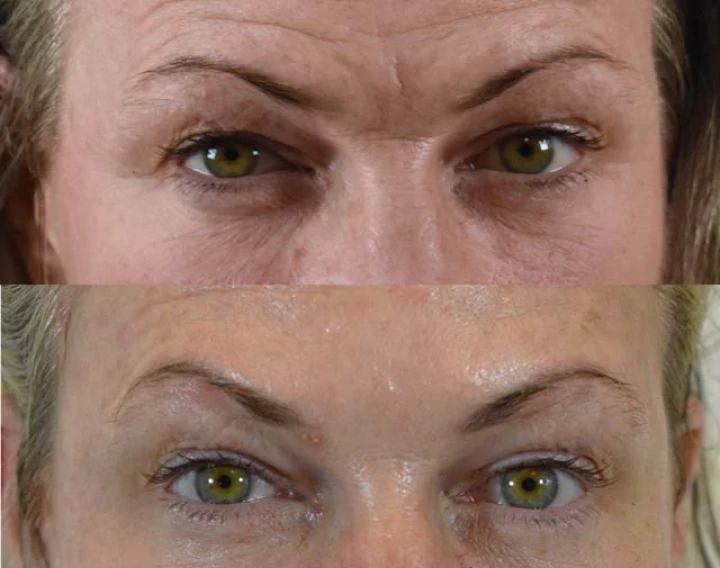 Dysport Under Eyes Before and After