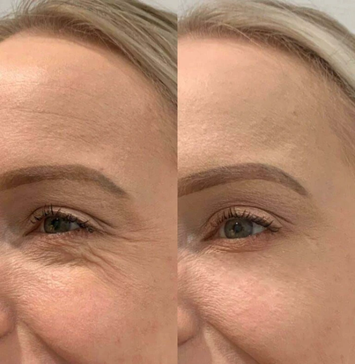 Dysport for Crows Feet Before and After