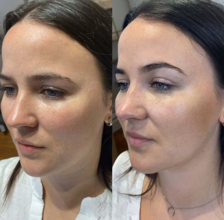 Eyebrow Lift Dysport Before and After