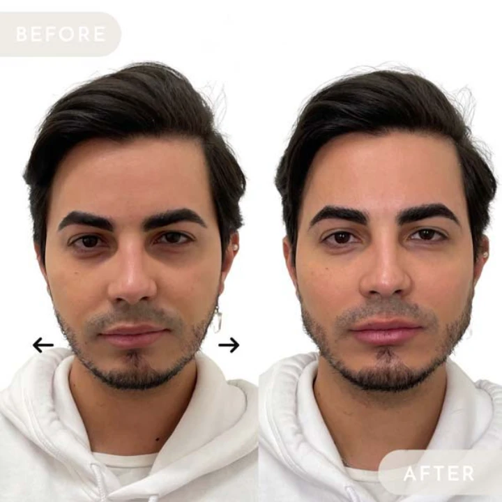 Face Fillers for Men