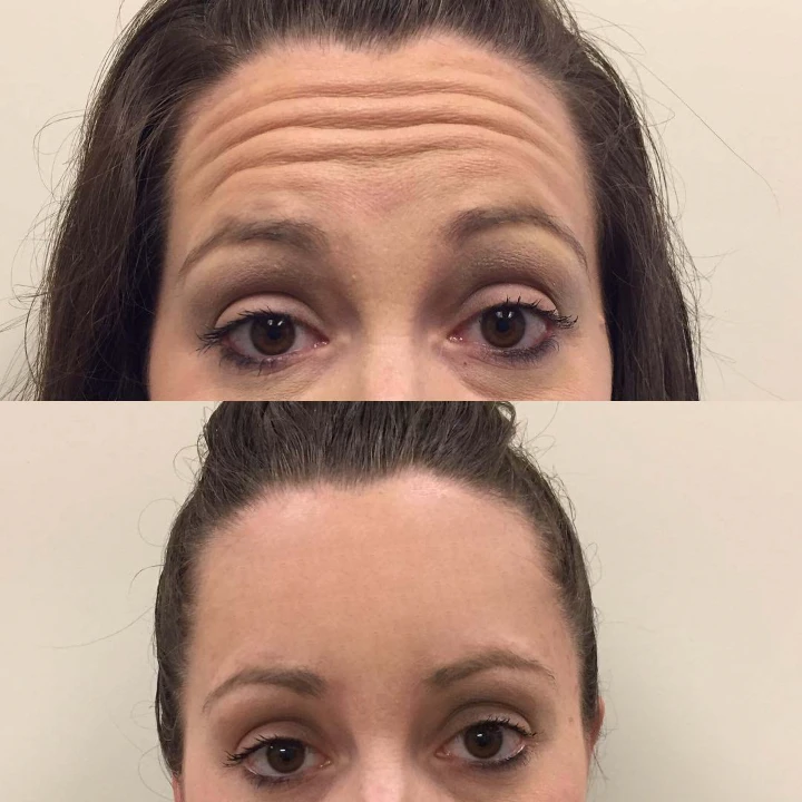 Forehead Botox Before and After