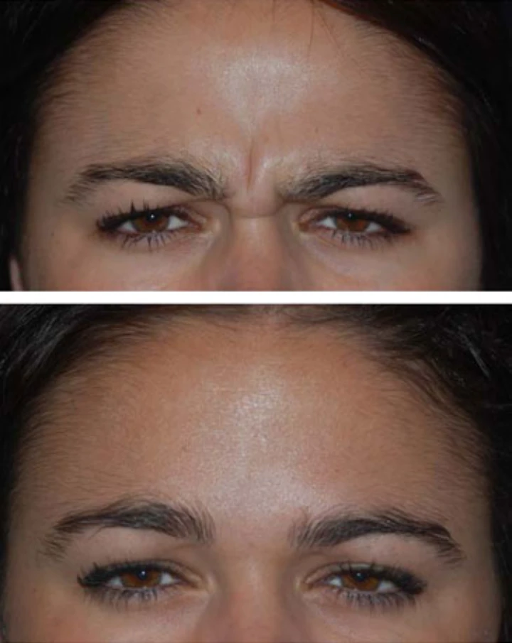 Frown Lines Botox Before and After