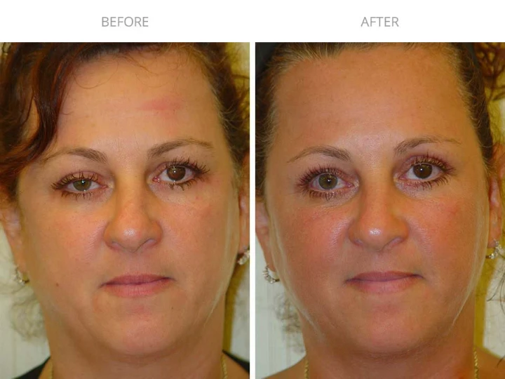 Botox Brow Lift for Hooded Eyes