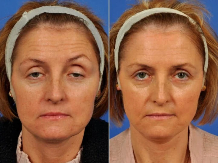 Botox Brow Lift for Hooded Eyes