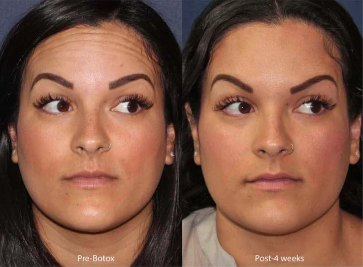 How Often Should You Get Botox