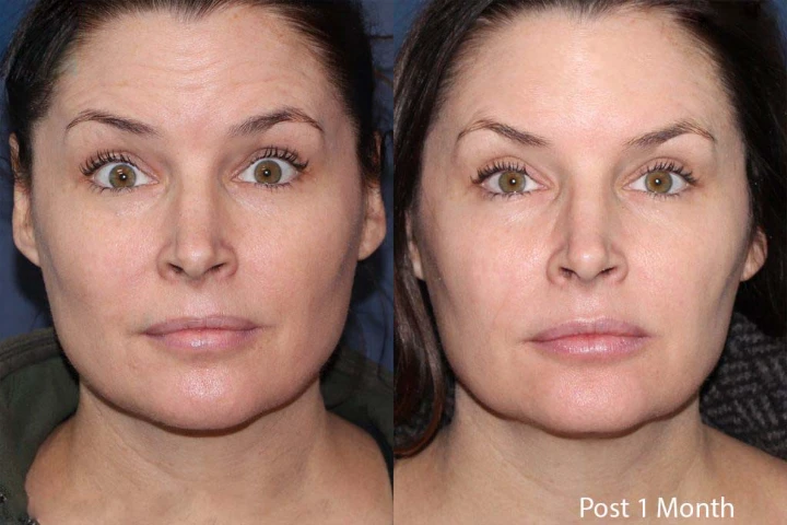 How Often Should You Get Botox