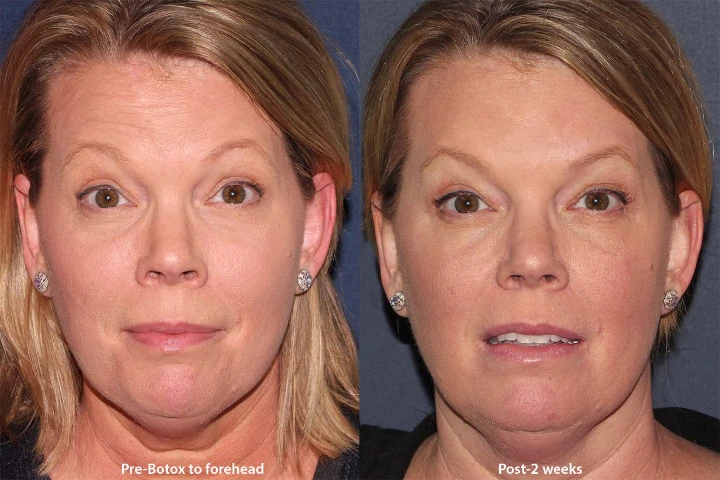 How Often Should You Get Botox in Your 40s