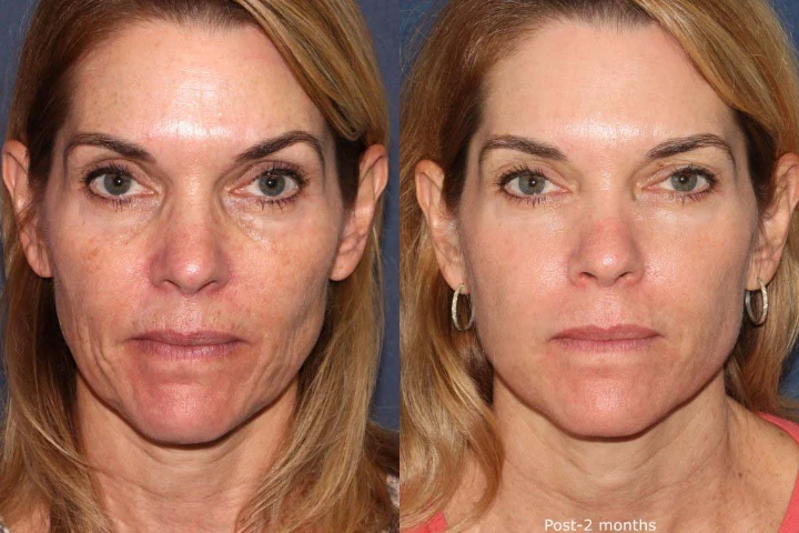 How Often Should You Get Botox in Your 50s