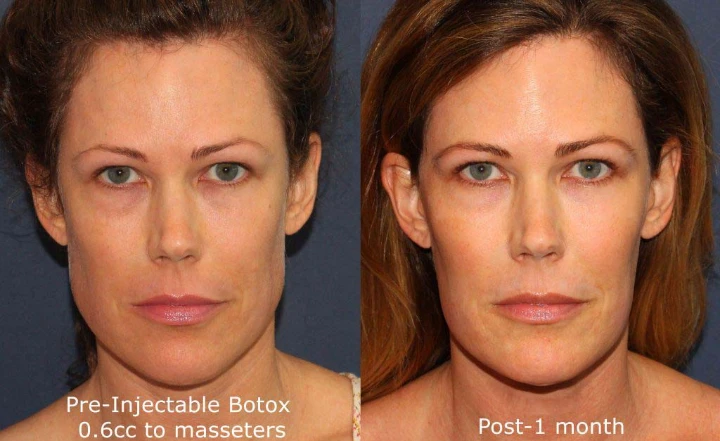 How Often Should You Get Masseter Botox