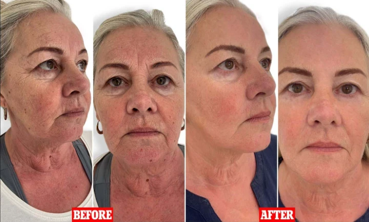 How often should you get Botox in your 50s