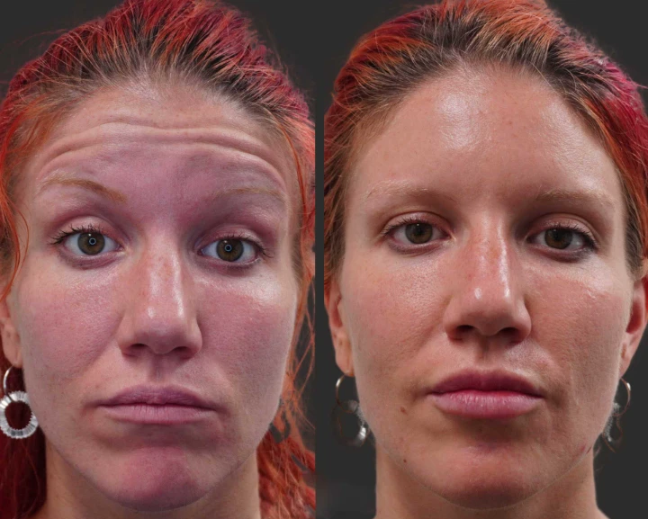 Images of Before and After Botox