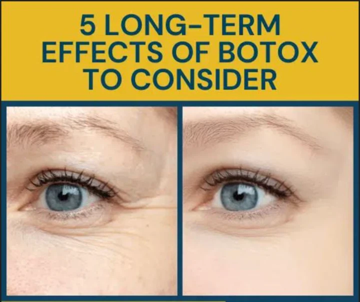 Long Term Effects of Botox