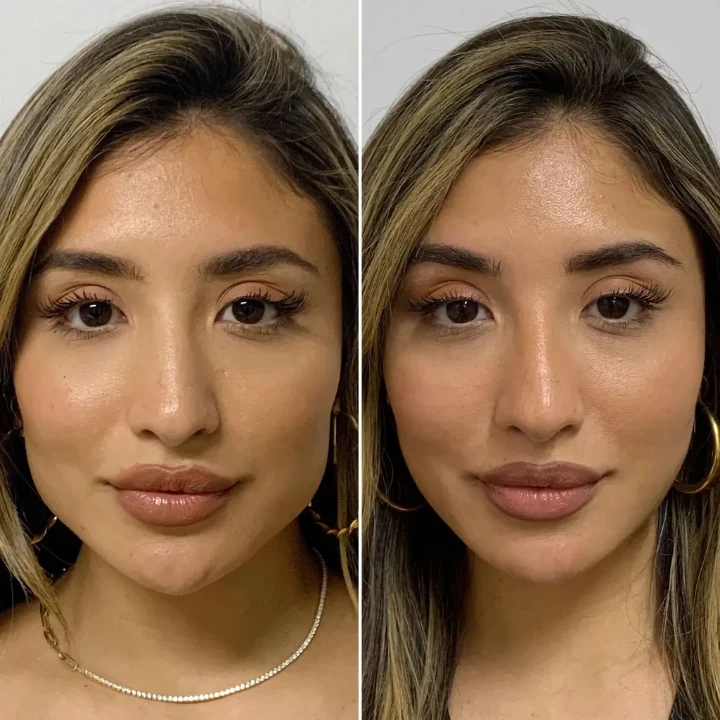 Masseter Botox Before and After