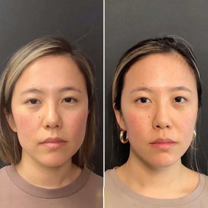 Masseter Botox Before and After