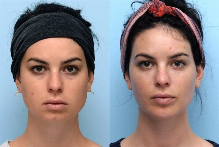 Masseter Botox Before and After