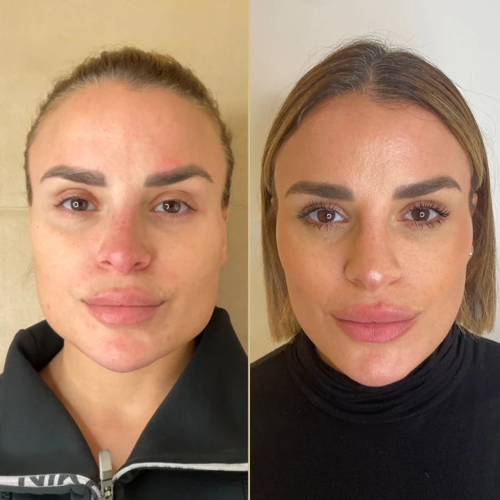 Masseter Botox Before and After