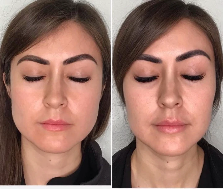 Masseter Botox Before and After