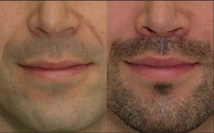 botox on men before and after