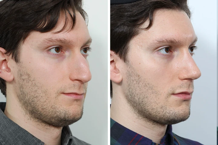 Botox on men before and after