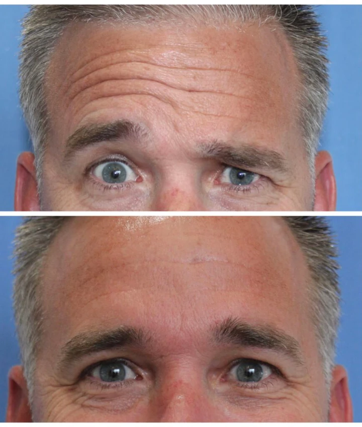 Botox on men before and after