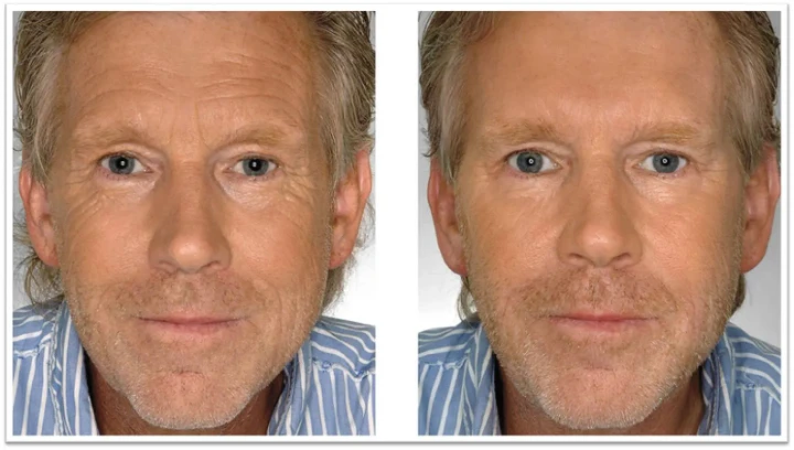 botox on men before and after