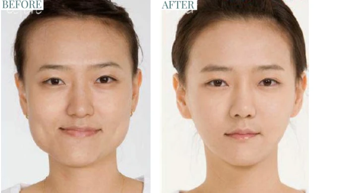 jaw botox before and after