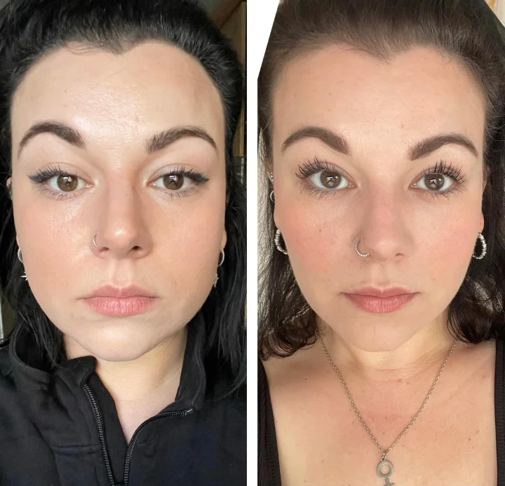 jaw botox before and after