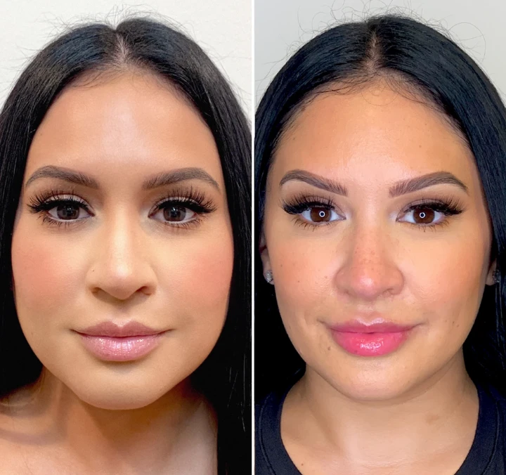 jaw botox before and after