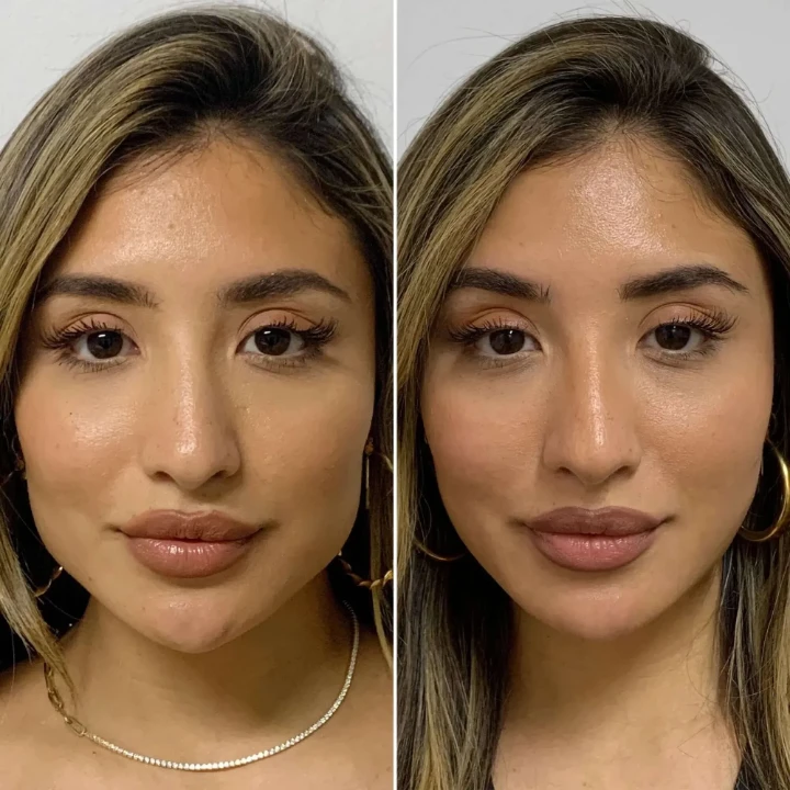 jaw botox before and after