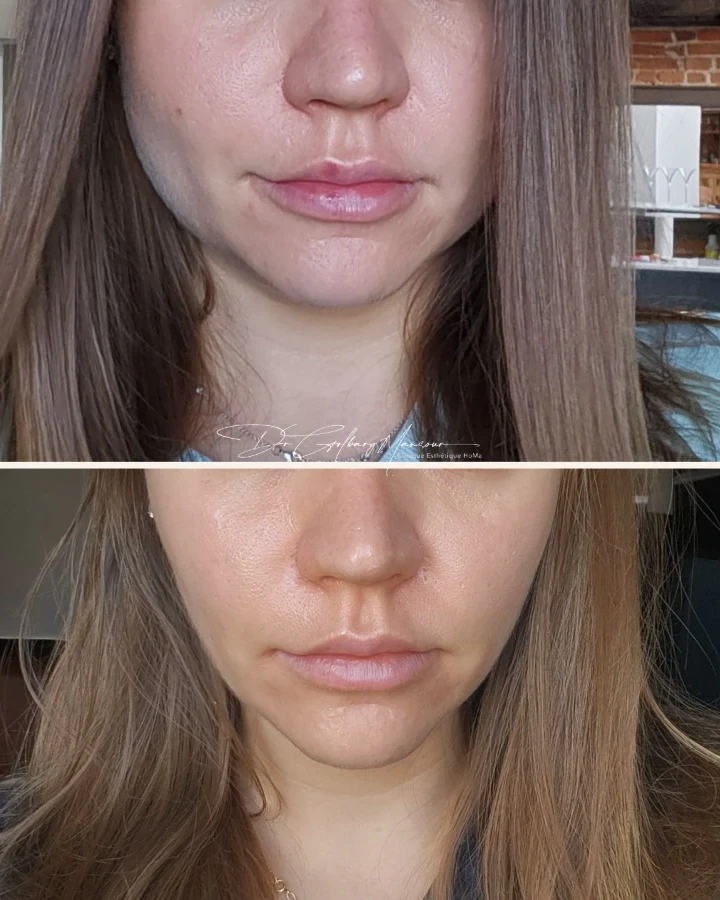 jaw botox before and after