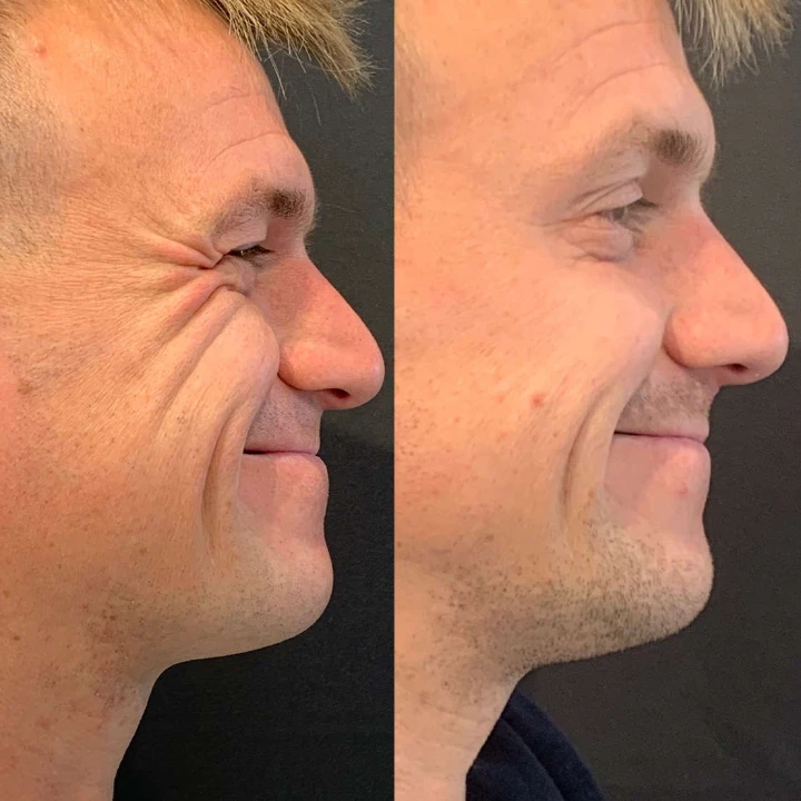 Botox Before and After Pictures