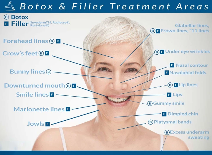 Botox Chart