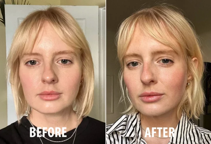 Botox Chin Before and After