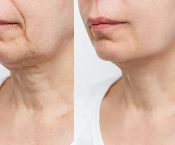 Botox Chin Before and After