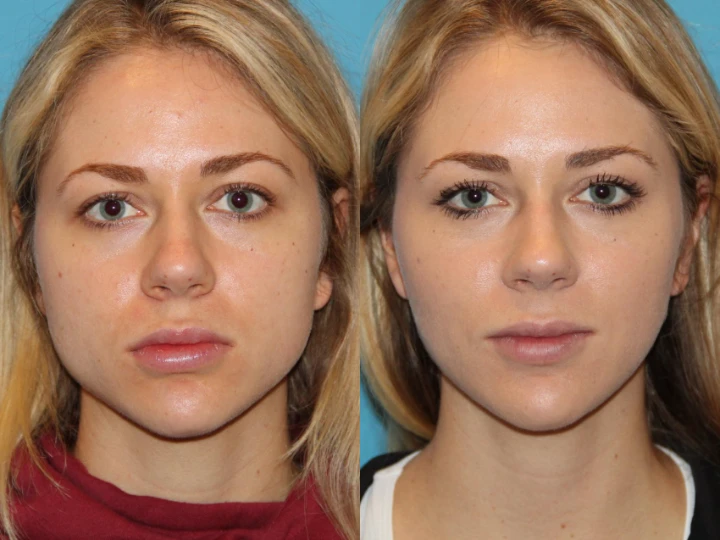 Botox Chin Before and After