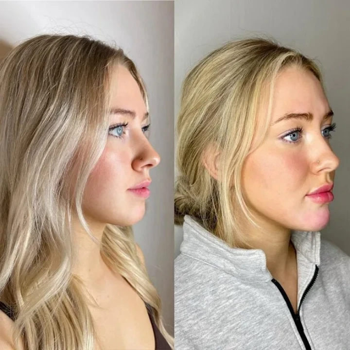 Botox Chin Before and After