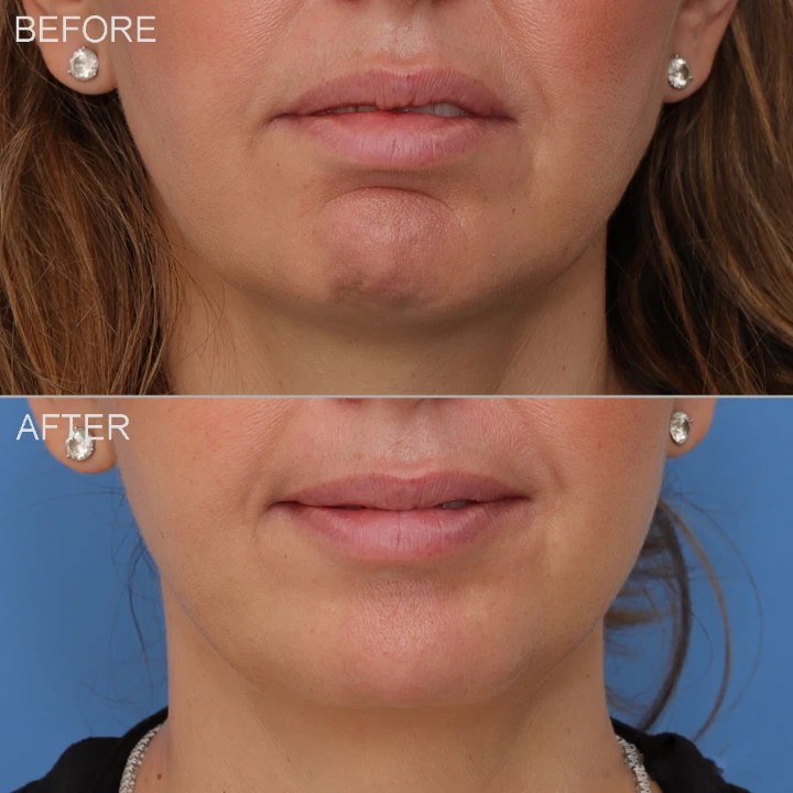 Botox Chin Before and After