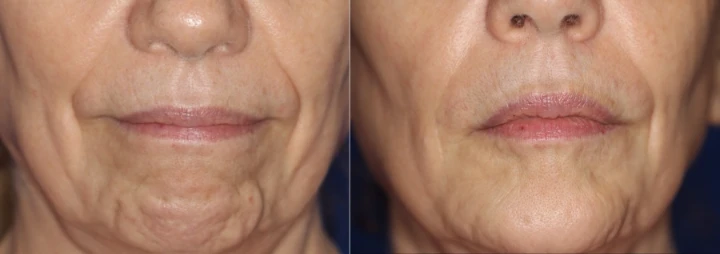 Botox Chin Before and After