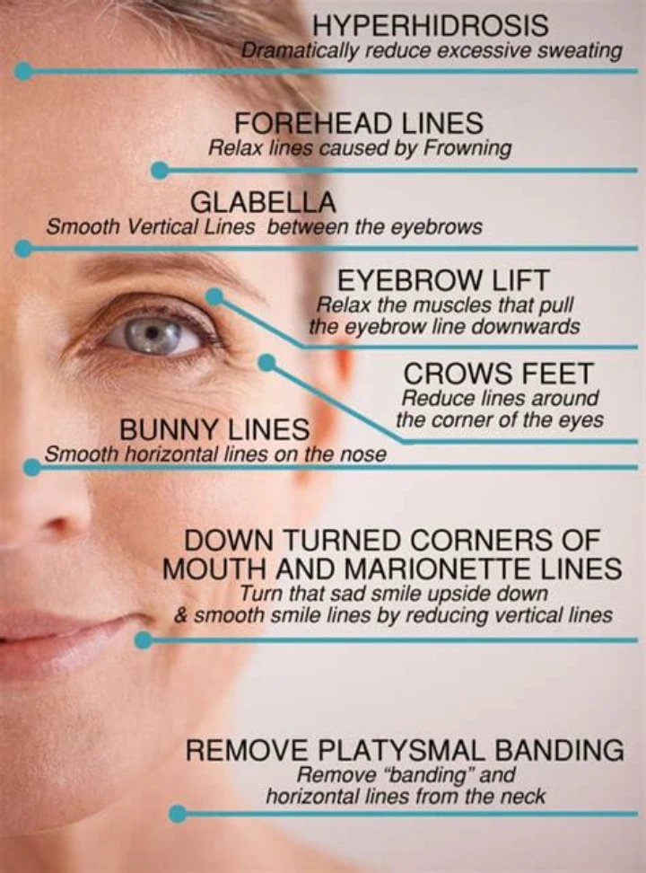 Botox Face Chart