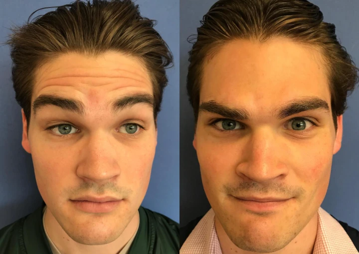 Botox Forehead Before and After Male