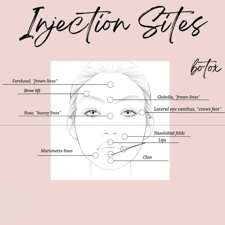 Botox Injection Sites Diagram