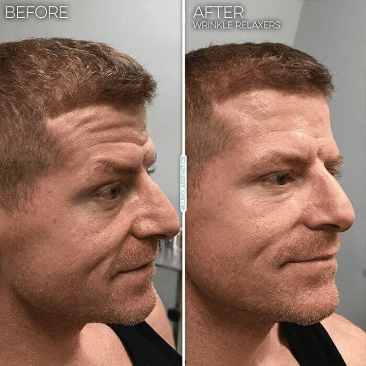 Botox Male Forehead Before and After