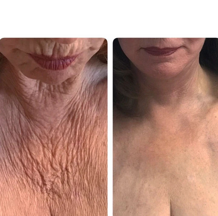 Botox and Neck chest