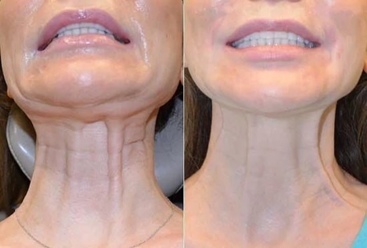 Botox and Neck