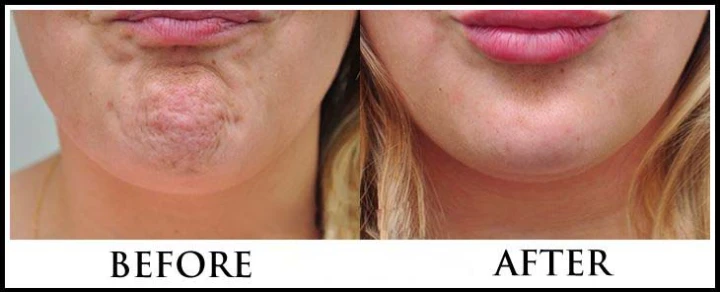 Botox for Double Chin Before and After