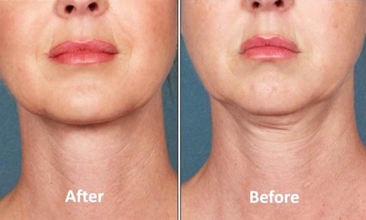 Botox for Double Chin